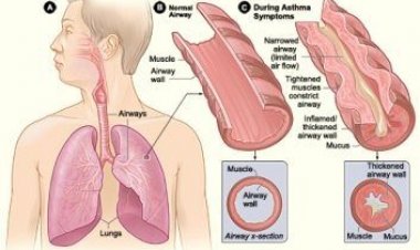 Τι είναι το άσθμα;