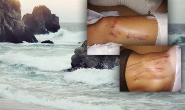 Mykonos: 40 ράμματα σε λουόμενη από τα απόνερα ταχύπλοου στην παραλία Κάπαρη