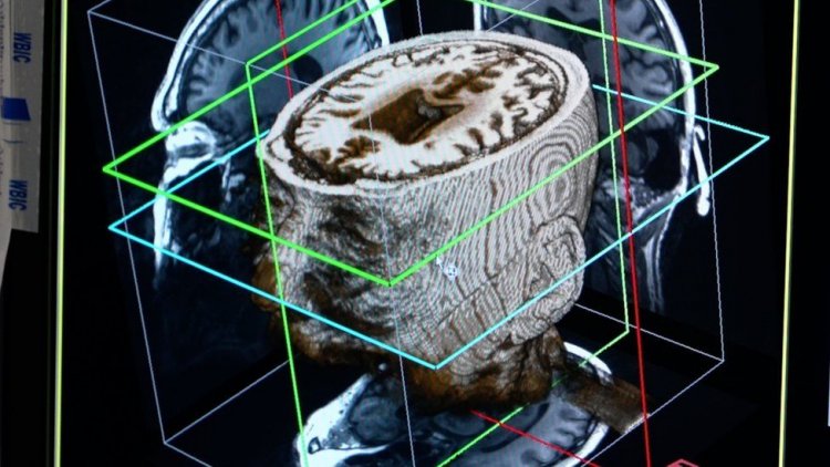 Artificial Intelligence: Η τεχνητή νοημοσύνη θα μπορούσε να χρησιμοποιηθεί για τη διάγνωση της άνοιας