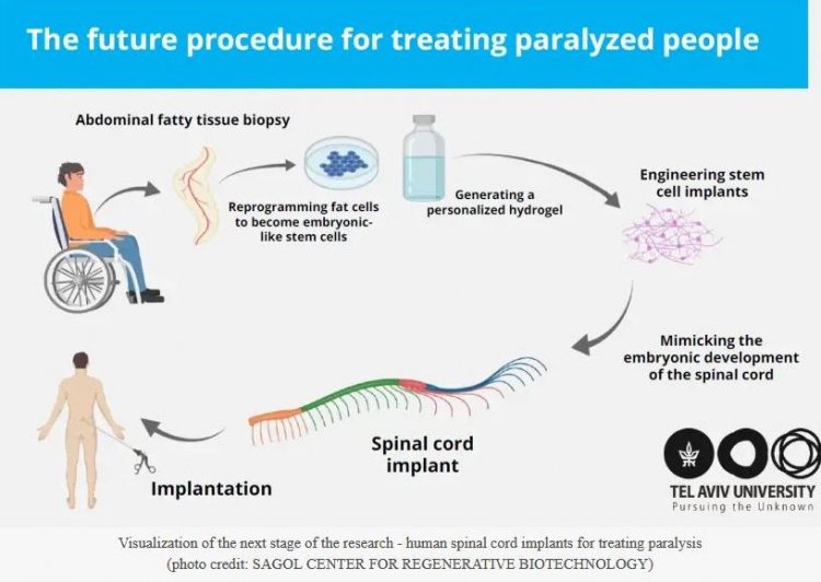 3D human spinal cord: Τα πρώτα βιοτεχνολογικά εμφυτεύματα σπονδυλικής στήλης για θεραπεία της παράλυσης δημιούργησαν επιστήμονες