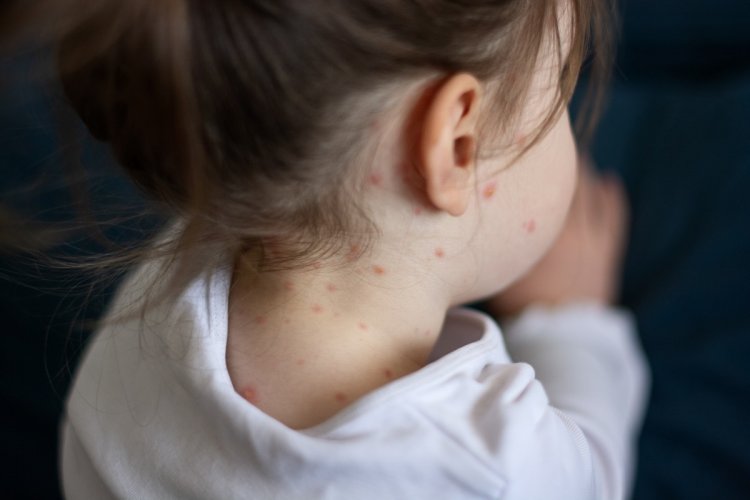 Measles: Η ιλαρά είναι πολύ χειρότερερη από τον κορωνοϊό!! Τα παιδιά πρέπει να κάνουν εμβόλιο, τονίζει η Παγώνη